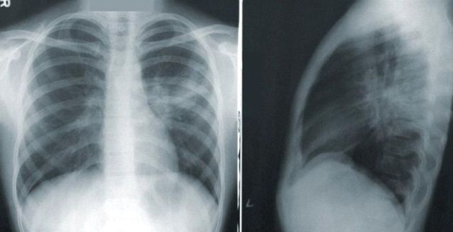Val de pneumonie într-o țară vecină cu China, în plină pandemie: 1772 de persoane au decedat