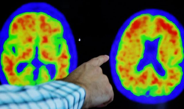 Un gigantesco mapa molecular abre el camino para curar el alzhéimer y el párkinson