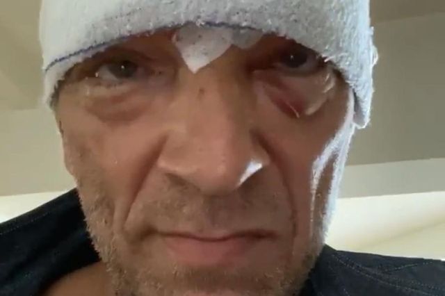 Incidente in moto per Vincent Cassel, l’attore mostra testa bendata e lividi