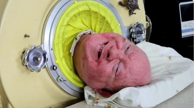 Polio-Infected Man, Who Spent 70 Years Inside An Iron Lung, Dies
