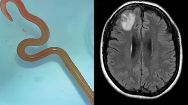 Australia, estratto un verme parassita lungo 8 centimetri dal cervello di una donna