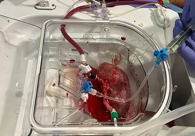 Prueban en cerdos una técnica pionera para reparar los órganos antes de un trasplante