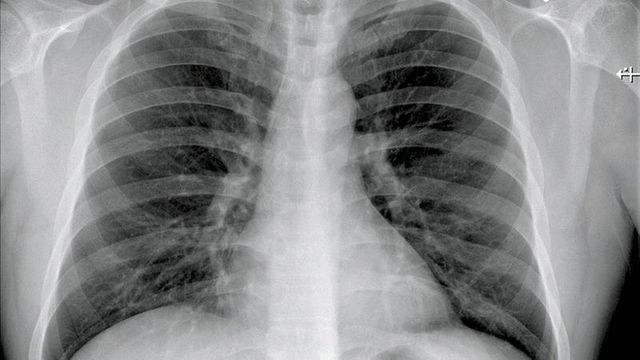 Noi studii arată că pacienții vindecați de Covid-19 rămân cu leziuni pulmonare după externare