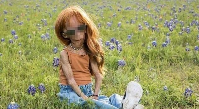 Morta Adalia Rose, la youtuber 15enne che raccontava la sua vita con la sindrome della progeria