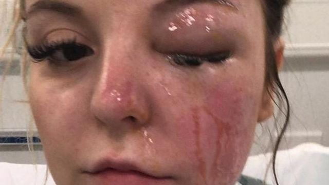 Британка обожгла глаза после попытки сварить яйца в микроволновке