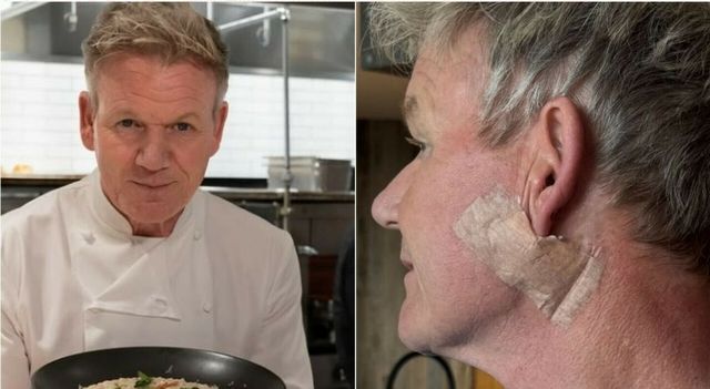 Lo chef Gordon Ramsay: 'Mi hanno tolto un tumore alla pelle'