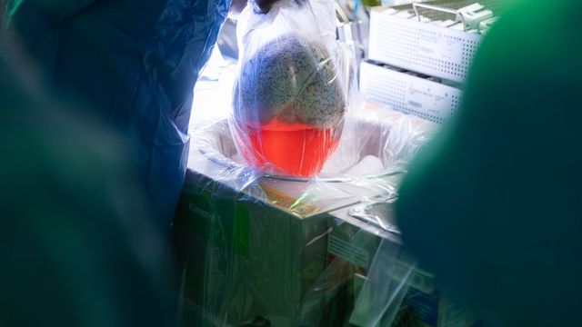 Trasplantan por primera vez un pulmón de cerdo a un humano en muerte cerebral