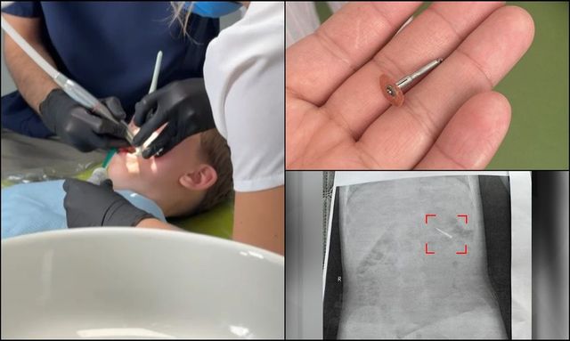 Scandal la o clinică stomatologică din Iași. Medicul i-a scăpat unui copil de 5 ani o freză pe gât