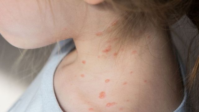 Увеличават се случаите на морбили у нас