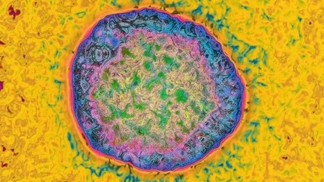 Muere Juan Maeso, el anestesista condenado por el contagio masivo de hepatitis C