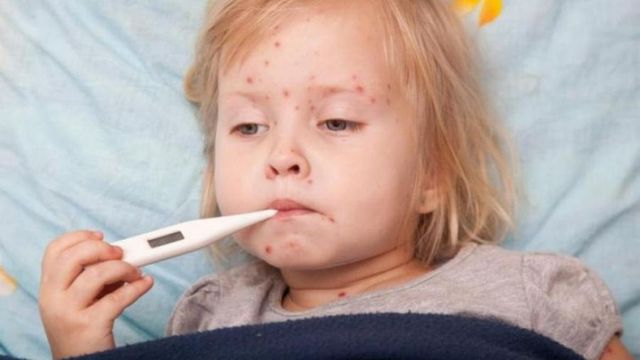 Ministerul Sănătății a declarat epidemie de rujeolă la nivel național