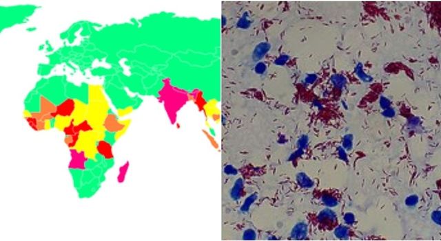 In Europa torna la lebbra, confermati casi in Romania e Croazia
