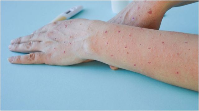 Ultima oră! Un caz de infecție cu virusul variolei maimuței, confirmat în Republica Moldova