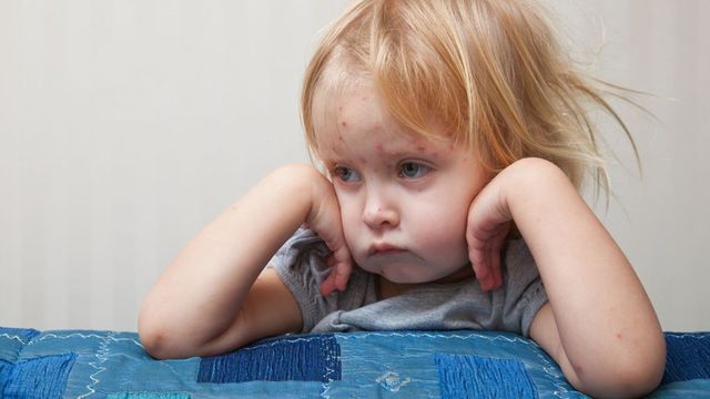 Нови случаи на морбили у нас, заболелите вече са 191 души