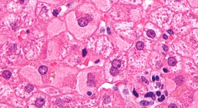 Epatite A, salgono a 53 i pazienti ricoverati al Cotugno di Napoli