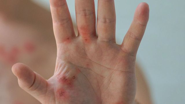 Galicia registra un nuevo brote de viruela del mono sin un origen claro