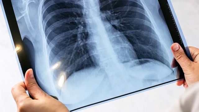 Săptămâna trecută, în capitală au fost înregistrate 14 cazuri de tuberculoză