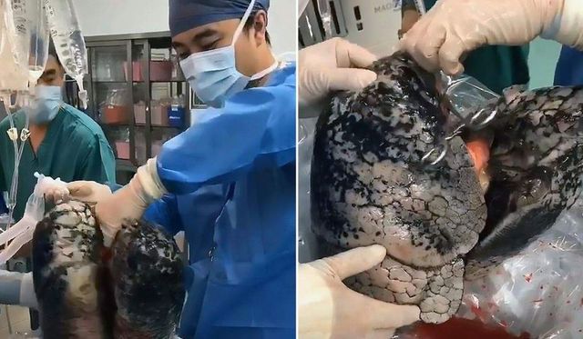 Medicii au dezvăluit cum arată plămânii unui bărbat care a fumat timp de 30 de ani un pachet de țigări pe zi