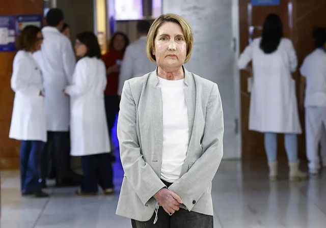 Primer trasplante de cara a partir de una donante fallecida por eutanasia