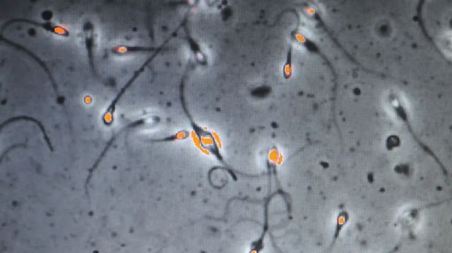 Dárce spermatu měl mutaci zvyšující riziko rakoviny, zplodil dvě stovky dětí