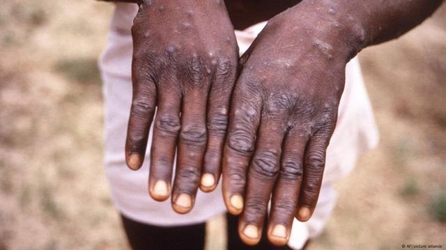 Mpox Declared Public Health Emergency By Africa After Massive Outbreak