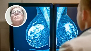 Sanidad solicita a Andalucía los informes del programa de cribado de cáncer de mama