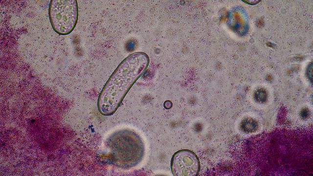 O infecție bacteriană cu simptome similare răcelii, dar cu mortalitate de 30% se răspândește rapid în Japonia