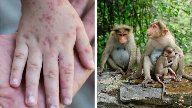 Variola maimuței: Ministerul Sănătății vine cu informații despre virusul care se răspândește pe continent și situația în țară