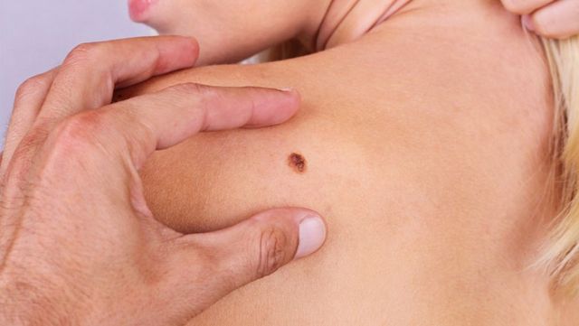 Peste 160 de moldoveni au fost diagnosticați cu cancer de piele în 2025