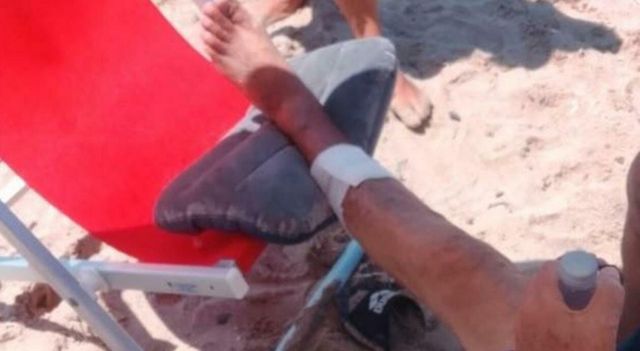 Turisti morsi a sangue dai pesci, allarme tra i bagnanti: è il secondo episodio in pochi giorni