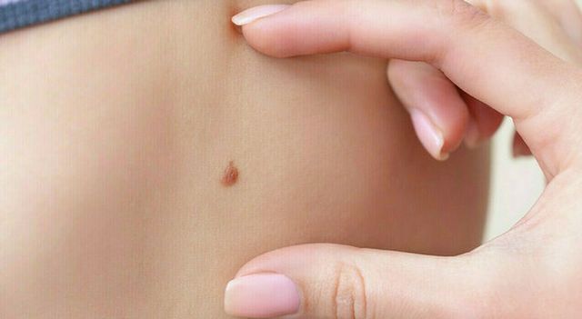 Melanoma, +30% di diagnosi nel 2024 ma cresce l'immunoterapia