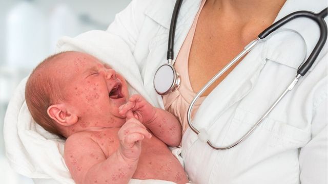 Проф. Ива Христова: Няма епидемия от морбили, а епидемичен взрив