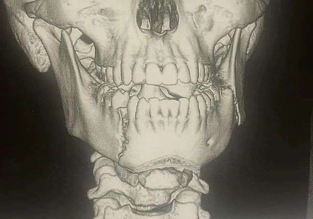 Un menor de 14 años, hospitalizado tras una grave agresión en un instituto de Fuengirola