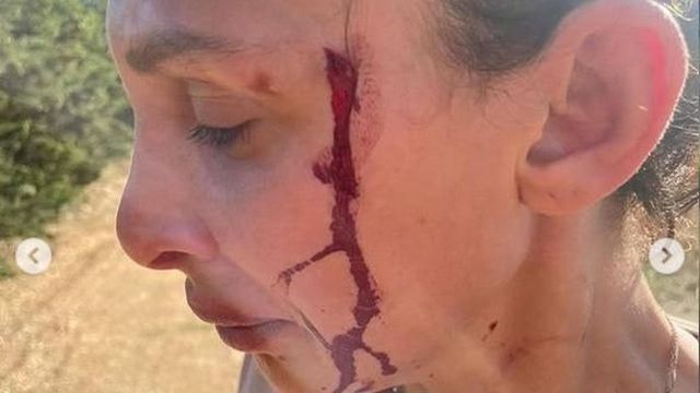 Sara Bluma rivela le foto delle violenze domestiche. Can Yaman: “Ti sosterrò”