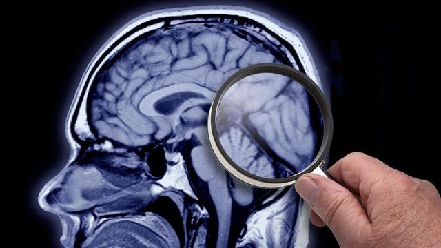 Alzheimer, ricercatori italiani scoprono nuovo gene che causa malattia