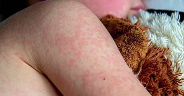 Desítky tisíc dětí v Česku nejsou očkované proti spalničkám