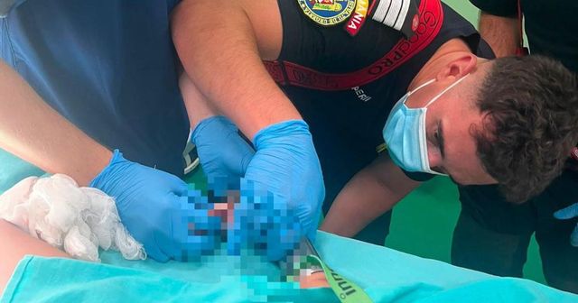 Un copil de 2 ani a ajuns în sala de operație, după ce și-a prins mâna în mașina de tocat. Cum a fost salvat