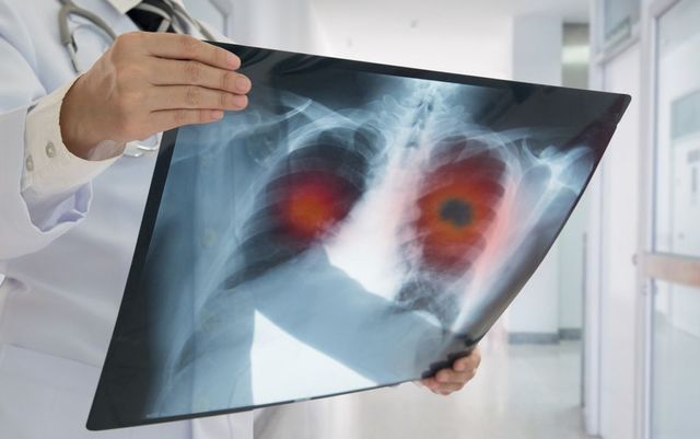 Românii pot afla dacă au risc de a dezvolta cancer pulmonar cu ajutorul unui test online